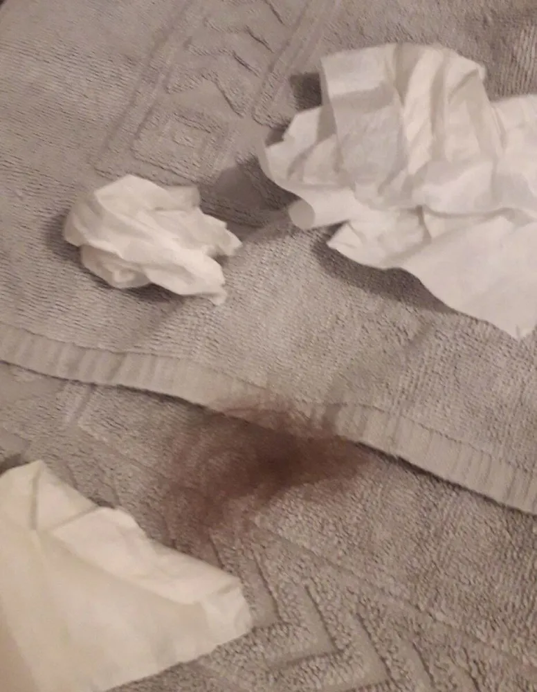 Apres un rhume et une calvitie